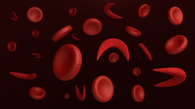 La dépranocytose est une déformation des globules rouges qui bouchent les vaisseaux sanguins (photo d'illustration)
