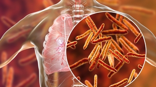 Tuberculose : La maladie menace de plus en plus les Marocains