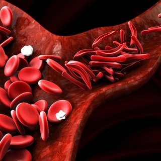 Drépanocytose : comment on devient malade